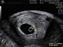6-week-ultrasound-picture.jpg